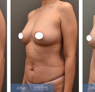 療程效果因人而異，上圖為D罩杯卻乳房下垂的女性在做完自體脂肪隆乳之後​手術後一個月、手術後八個月成效